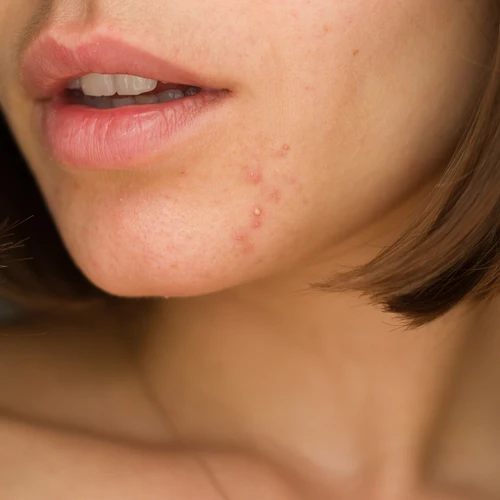 Adult acne and sensitive skin often coexist. Discover why aggressive treatments worsen inflammation and how to restore balance with a smarter routine.